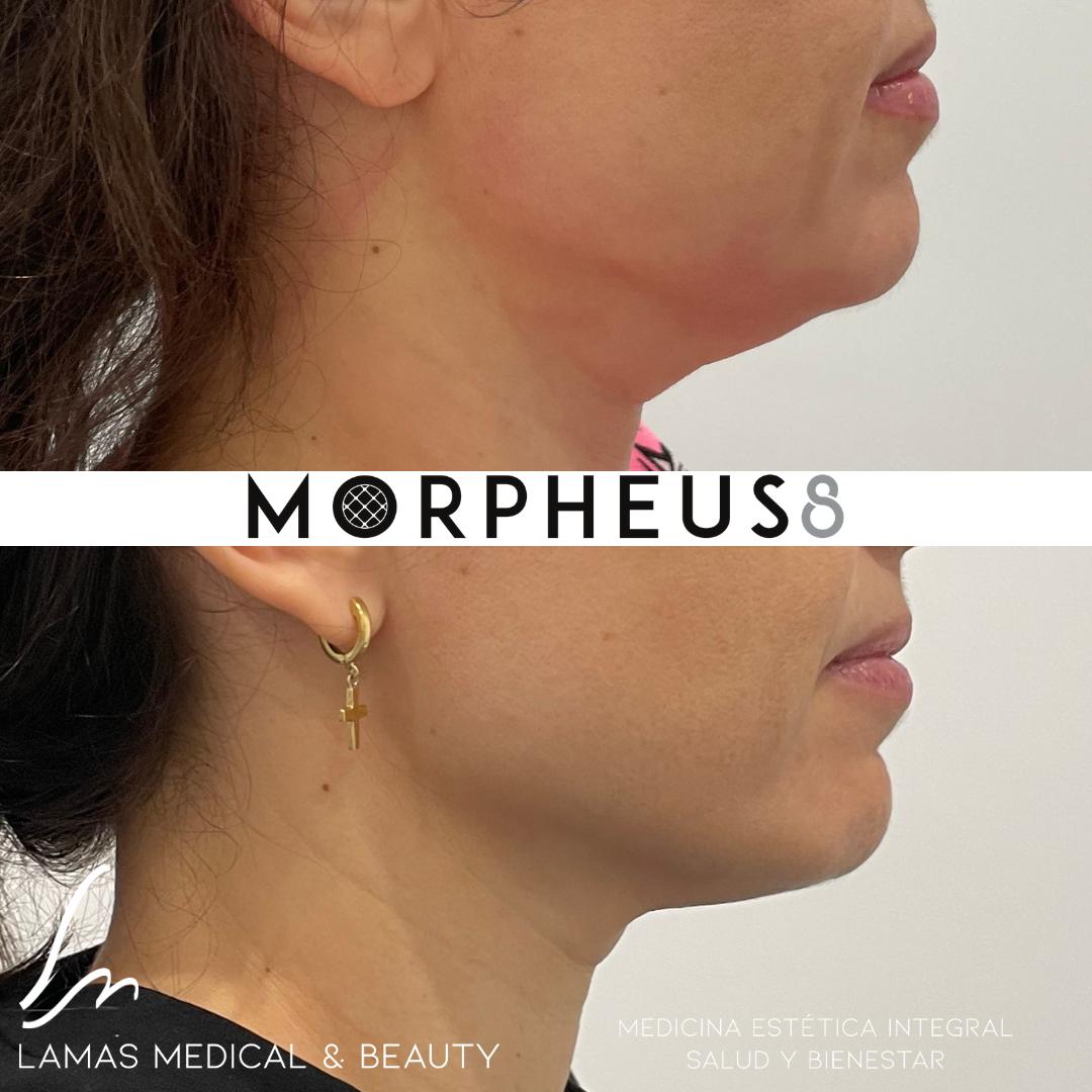 Morpheus8 antes y después, línea mandibular y cuello — caso real Clínica Lamas Madrid