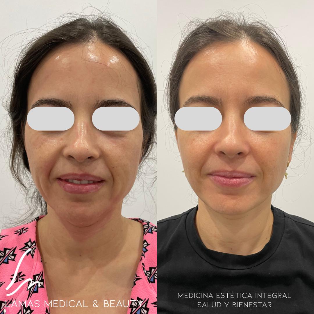 Morpheus8 antes y después, rostro y óvalo facial — caso real Clínica Lamas Madrid
