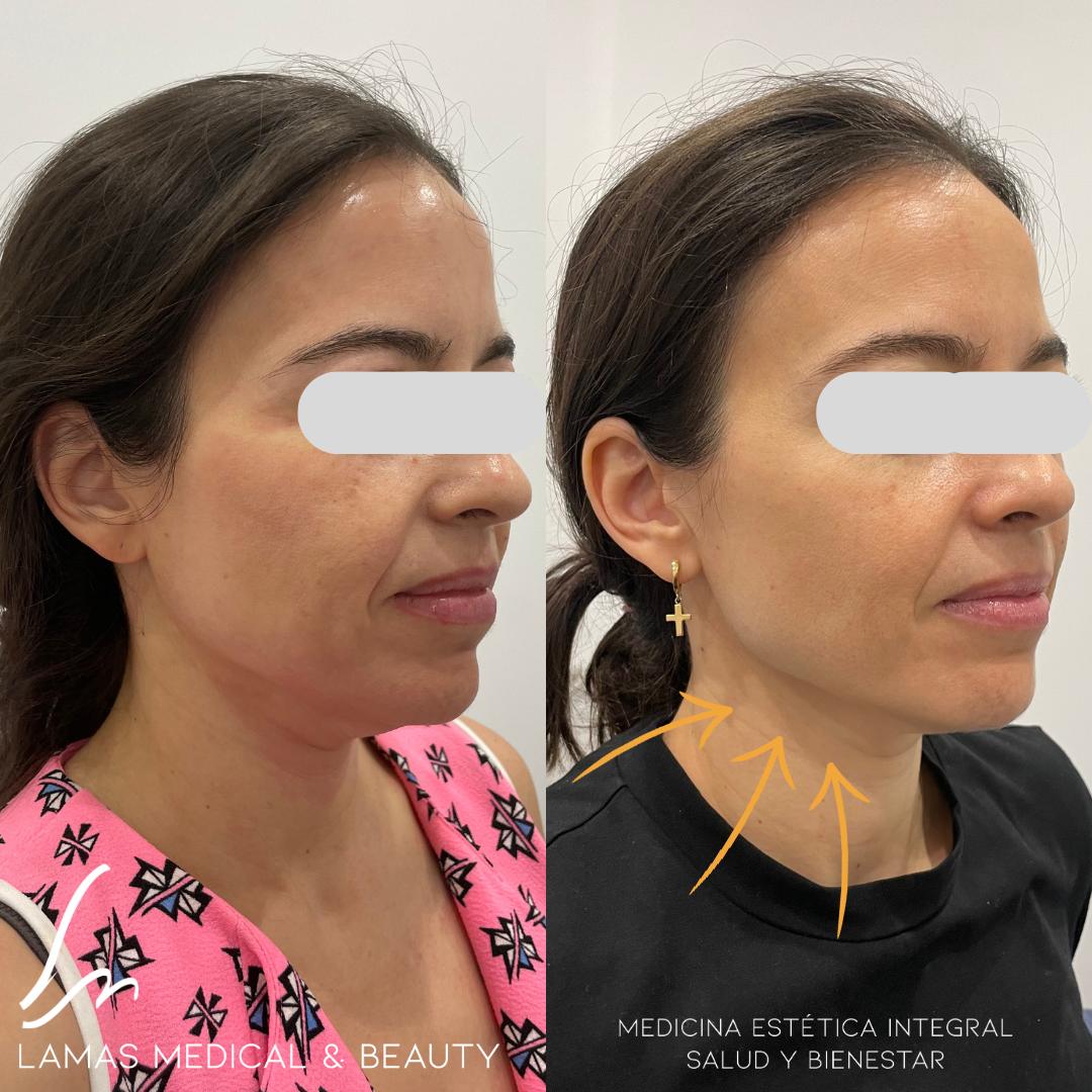 Morpheus8 antes y después, rejuvenecimiento facial — Clínica Lamas Madrid