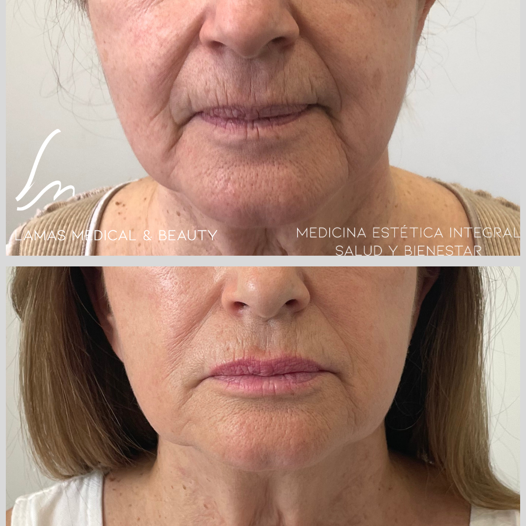 Morpheus8 antes y después facial — Clínica Lamas Madrid